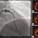 Acute Coronary Syndrome