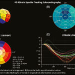 4D XStrain Speckle Tracking Echocardiography