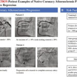 Identifying Risk Factors for Native Coronary Atherosclerosis Progression