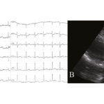 Immediate Interventional Management of Aortocoronary Dissection During PCI