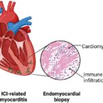 Diagnosing Immune Checkpoint Inhibitor