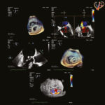 percutaneous mitral valve repair with PASCAL Ace system 