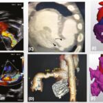 Giant coronary cameral fistulae
