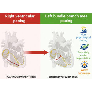 LBBAP, dyssynchrony, ventricular, Cardiomyopathy